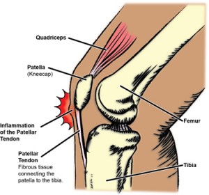 knee - pateller tendon inflammation